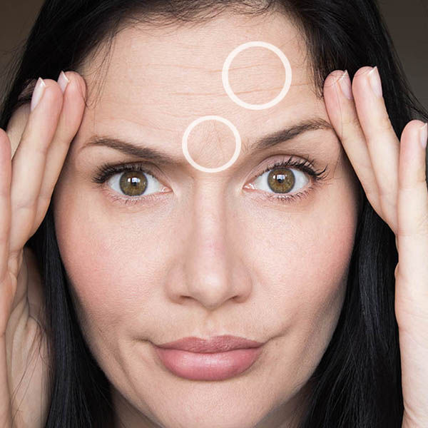 Как избавиться от мимических морщин на лице? - статьи многопрофильной клиники «Дезир»
