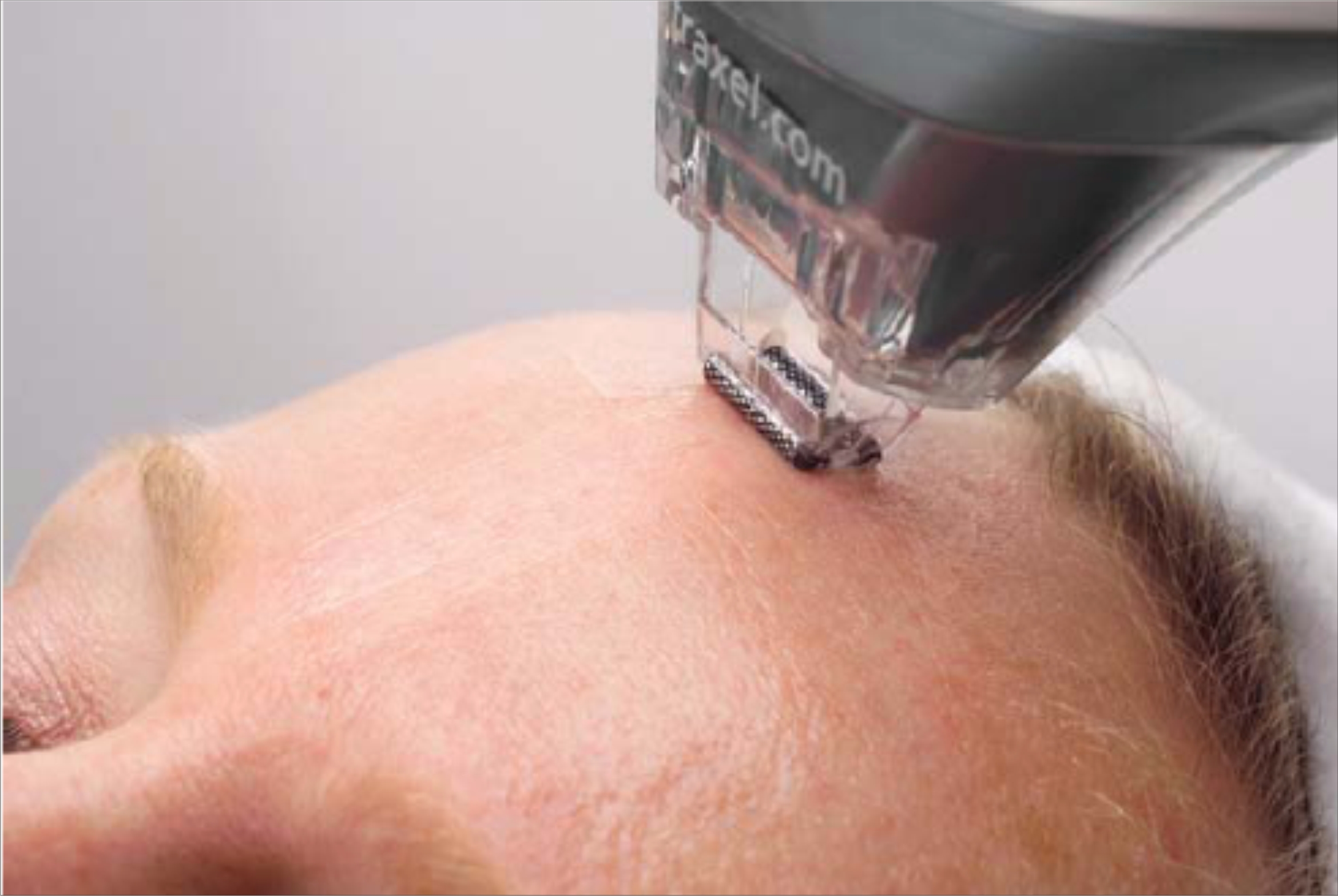 Лазерное воздействие на кожу skinlift ru. Фракционный лазерный фототермолиз кожи. Дырочки от фракционного фототермолиза на коже головы.